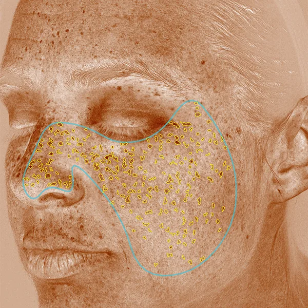 VISIA® Analyse: Braune Flecken – Hyperpigmentierungen