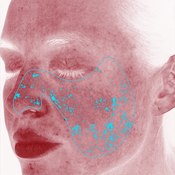 VISIA® Analyse: Rote Bereiche – Rötungen und Gefäßveränderungen