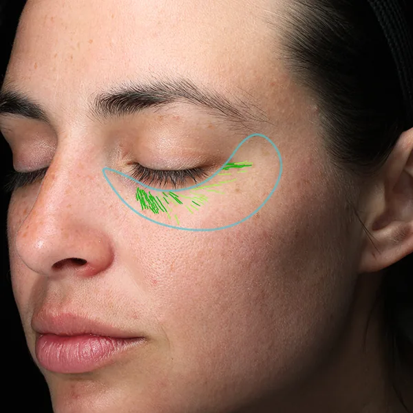 VISIA® Analyse: Falten – Tiefe und Verteilung